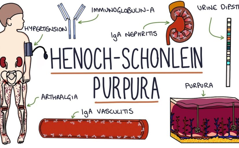 HENOCH-SCHONLEIN PURPURA